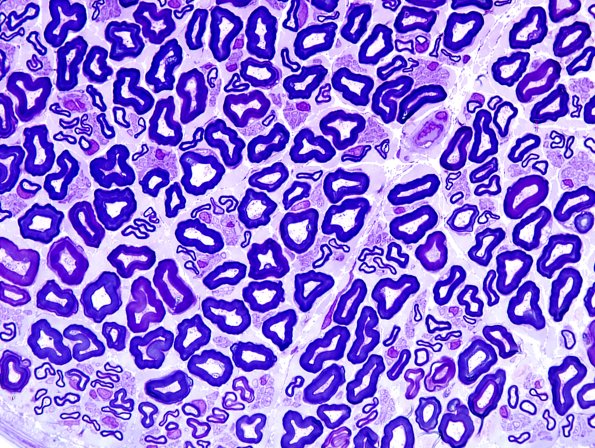 6A5 Normal nerve (Case 6) Plastic 2.jpg