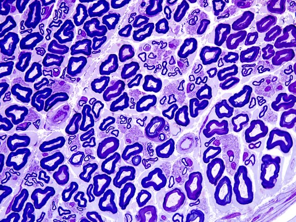 6A6 Normal nerve (Case 6) Plastic 4.jpg