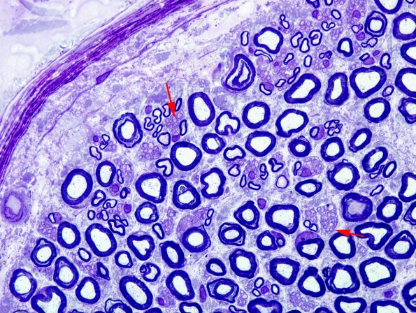 6A7 Remak Bundle, normal (Case 6) Plastic 100X 3 copy.jpg