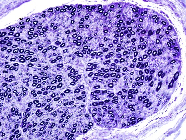 7A2 Nerve, normal (Case 7) Plastic 40X