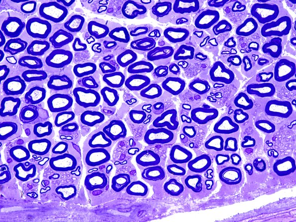9A Normal nerve (Case 9) Plastic 1.jpg