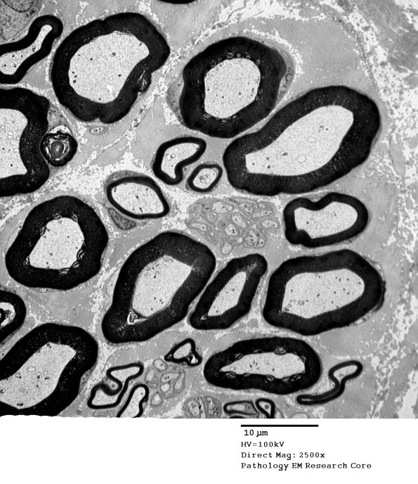 1A1 Normal Nerve (Case 1) new_013A - Copy A - Copy