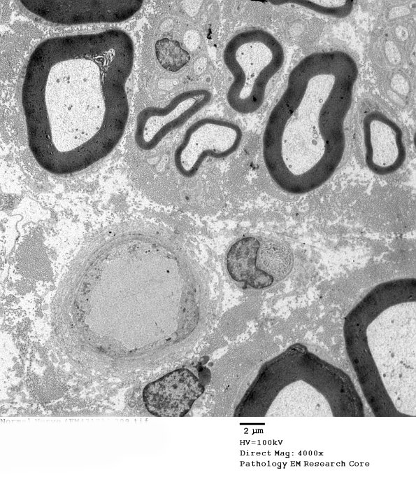 1A7 Normal Nerve (Case 1)_009 - Copy