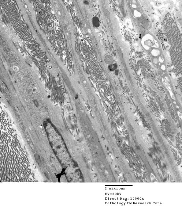 9A1 Normal perineurium, sural (Case 9) EM 036 - Copy