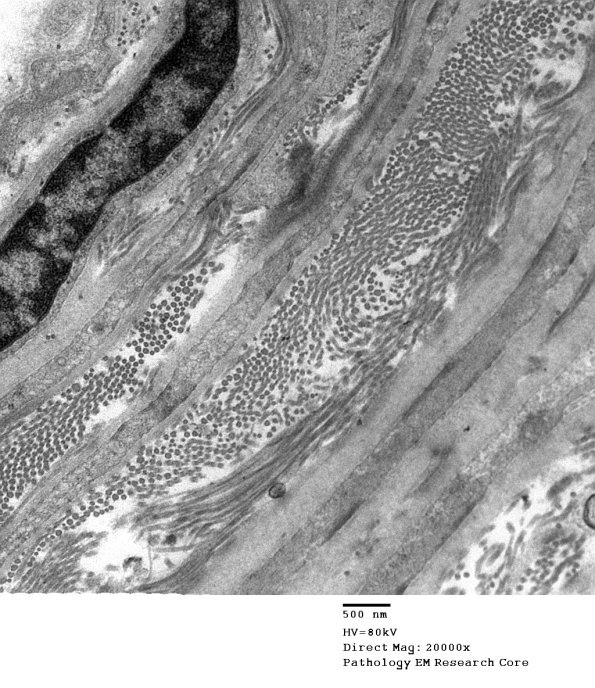 9A3 Normal perineurium, sural (Case 9) EM 050 - Copy