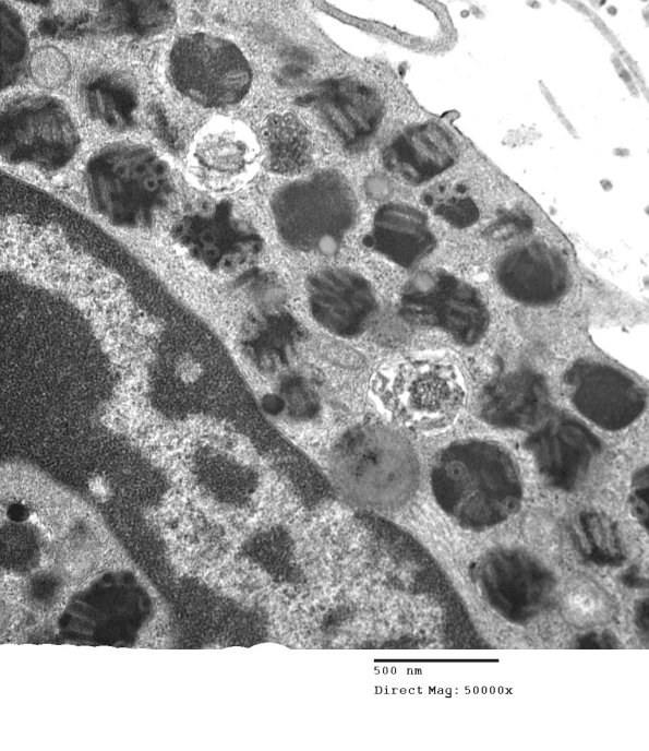 4A2 Mast Cell, nerve (Case 4)  EM 20 - Copy
