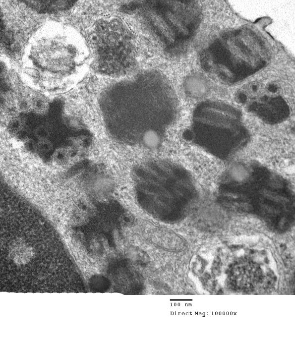 4A3Mast Cell, nerve (Case 4)  EM 22 - Copy
