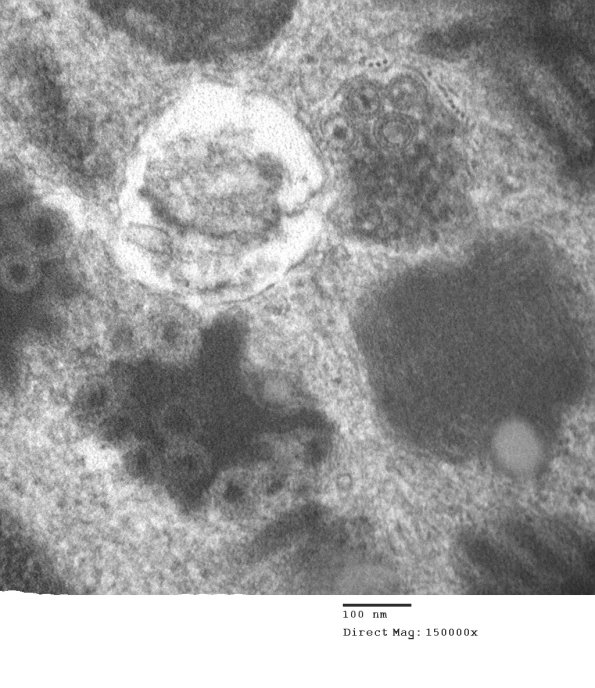 4A5 Mast Cell, nerve (Case 4)  EM 24 - Copy