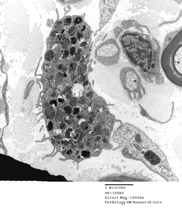 5A1 Mast cell, scrolls (Case 5) EM6 - Copy