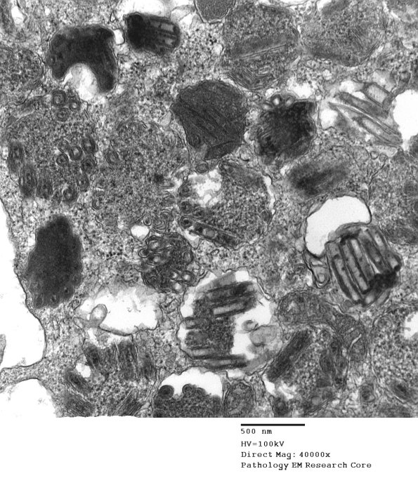 5A2 Mast cell, scrolls (Case 5) EM7 - Copy