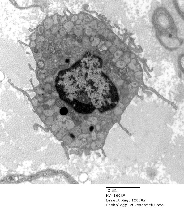 5A4 Mast cell (Case 5)_045 - Copy