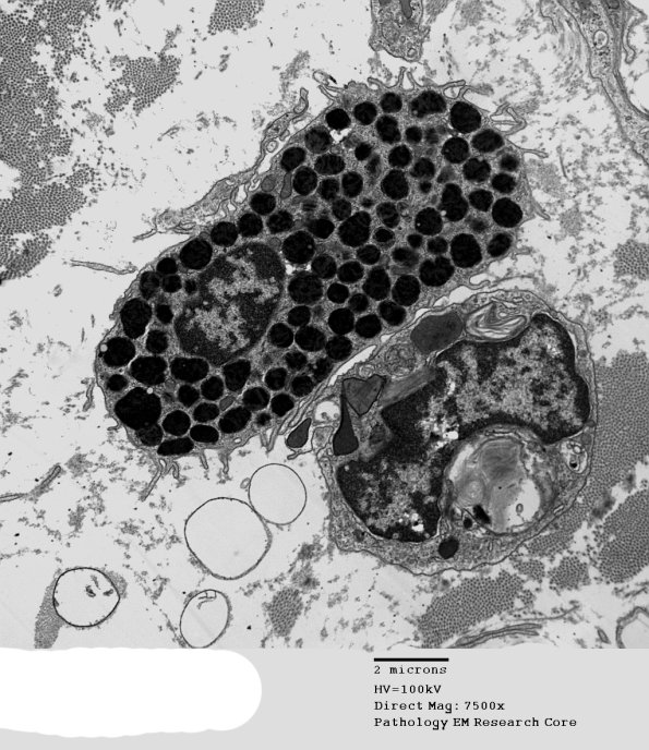 6A1 Axonal Degeneration (Case 6) EM 072 - Copy
