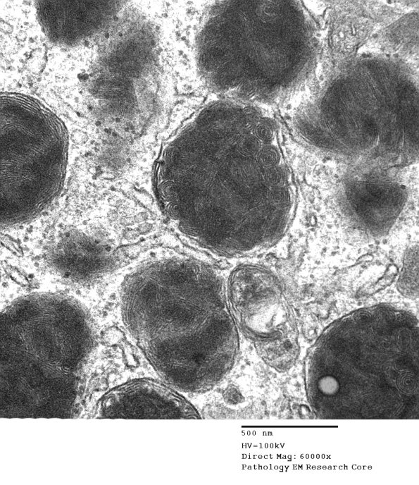 6A3 Axonal Degeneration (Case 6) EM 074 - Copy