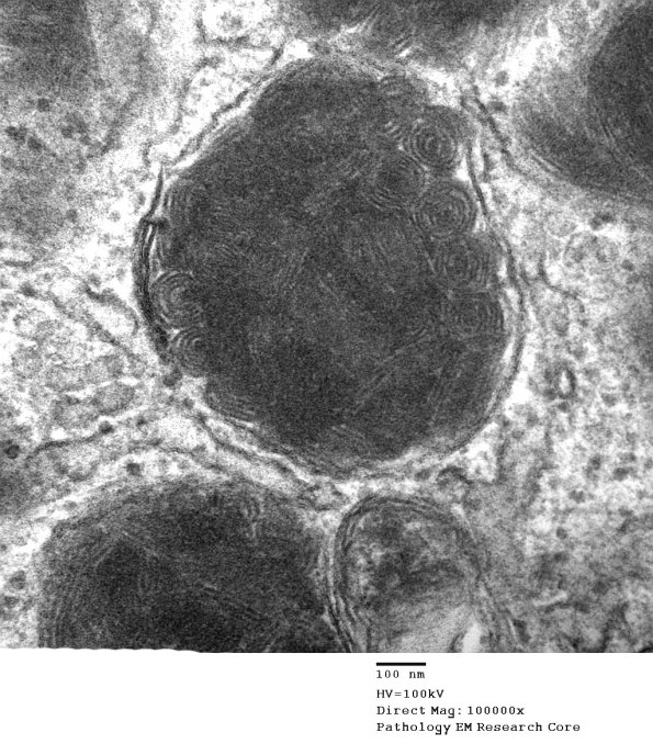 6A4 Axonal Degeneration (Case 6) EM 075 - Copy