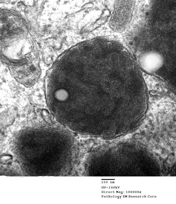 6A5 Axonal Degeneration (Case 6) EM 076 - Copy