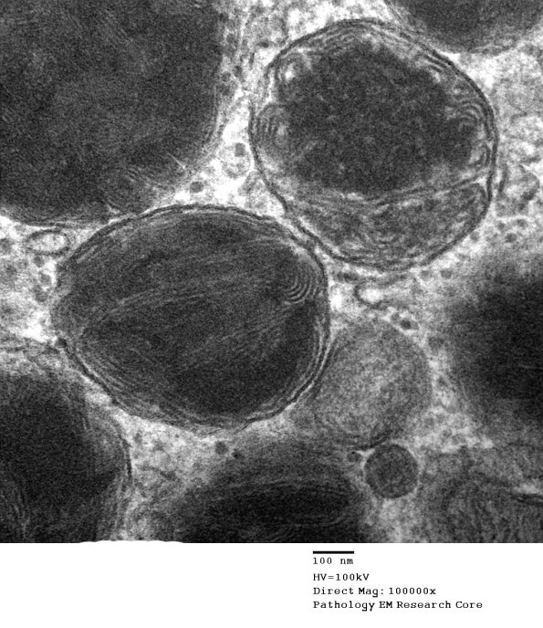 6A6 Axonal Degeneration (Case 6) EM 077 - Copy