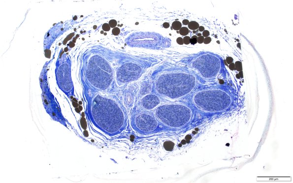 1A1 Normal Sural nerve, 3 mo age (Case 1) Plastic 10X scale bar