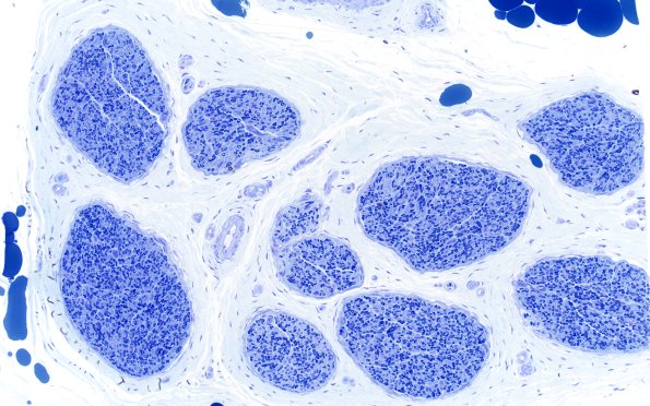 1A2 Normal Sural nerve, 3 mo age (Case 1) Plastic 20X 2