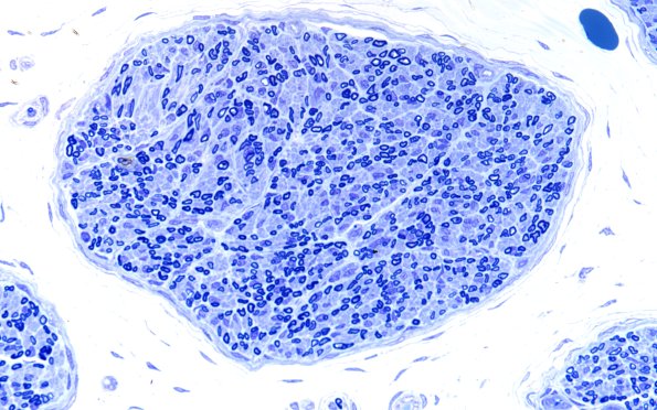 1A3 Normal Sural nerve, 3 mo age (Case 1) Blk2 Plastic 60X 4