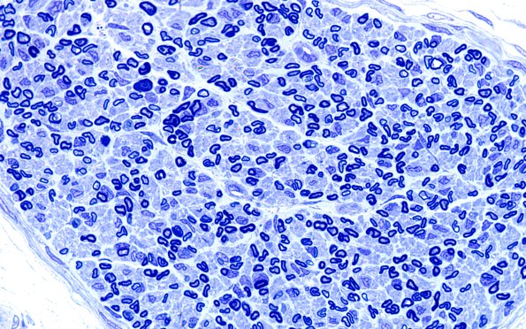 1A4 Normal Sural nerve, 3 mo age (Case 1) Blk2) Plastic 100X 4