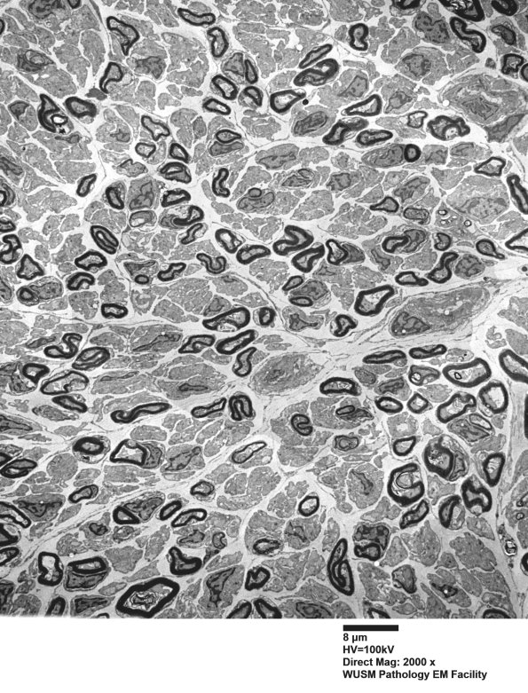 1B1 (Case 1) EM 010 - Copy