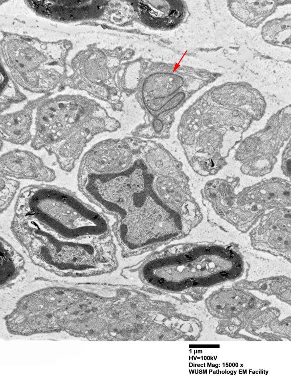 1B5 (Case 1) EM 020 - Copy copy
