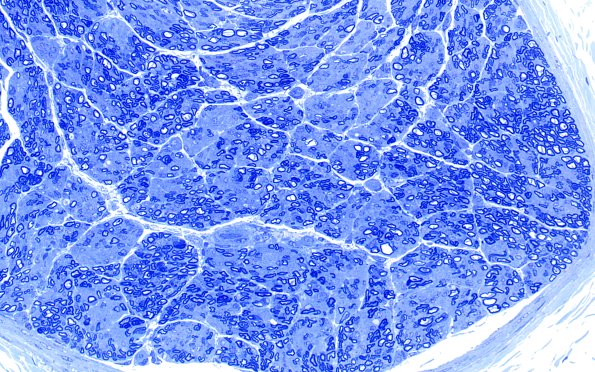 2A1 Child Sural (Case 2) 9wk old Plastic 40X 1