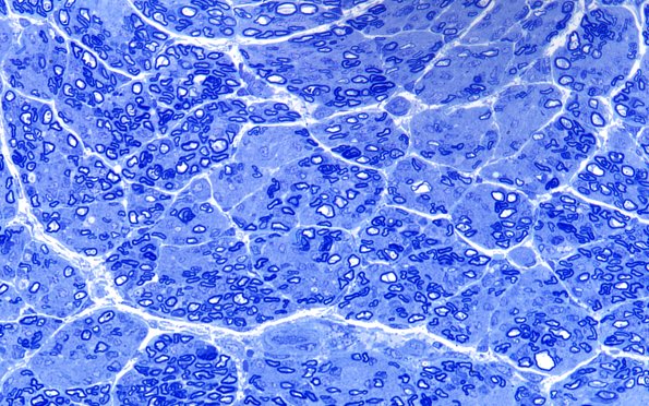 2A2 Child Sural (Case 2) 9wk old Plastic 60X 1