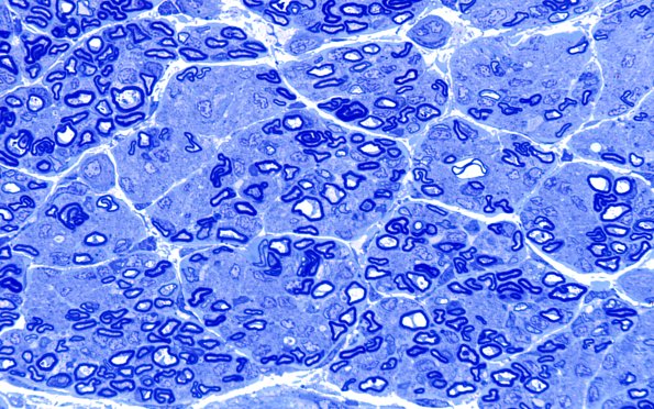 2A3 Child Sural (Case 2) 9wk old Plastic 100X 1