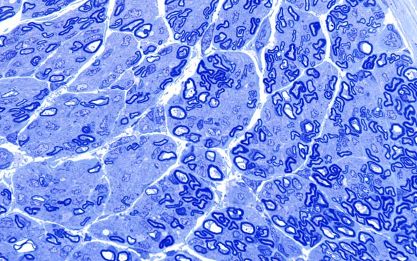 2A4 Child Sural (Case 2) 9wk old Plastic 100X 2