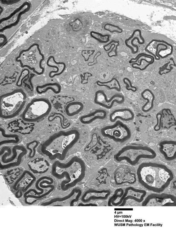 2B1 W20-132 A (Case 2) tibial_001 - Copy