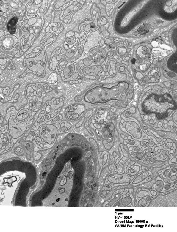 2B10 W20-132 A (Case 2) tibial_014 - Copy