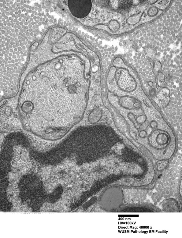 2B11 W20-132 A (Case 2) tibial_016 - Copy