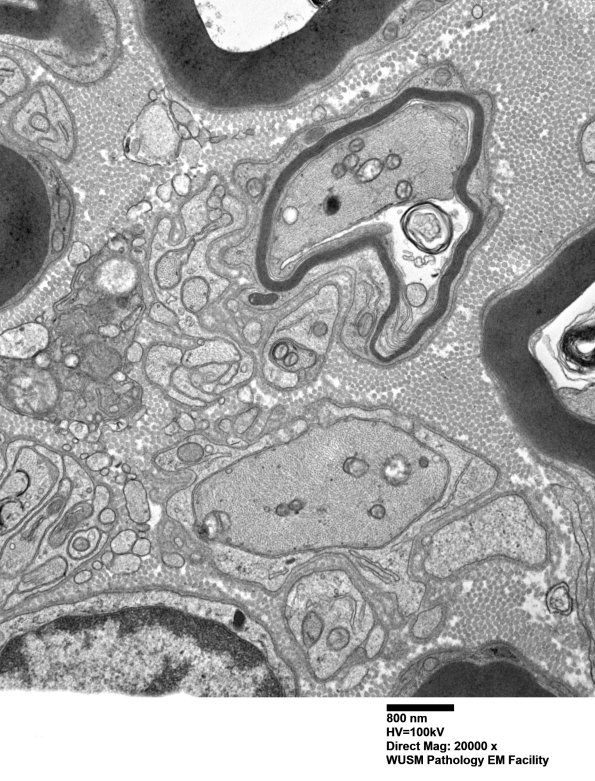 2B12 W20-132 A (Case 2) tibial_018 - Copy