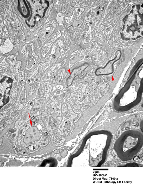 2B2 W20-132 A (Case 2) tibial_003 - Copy copy