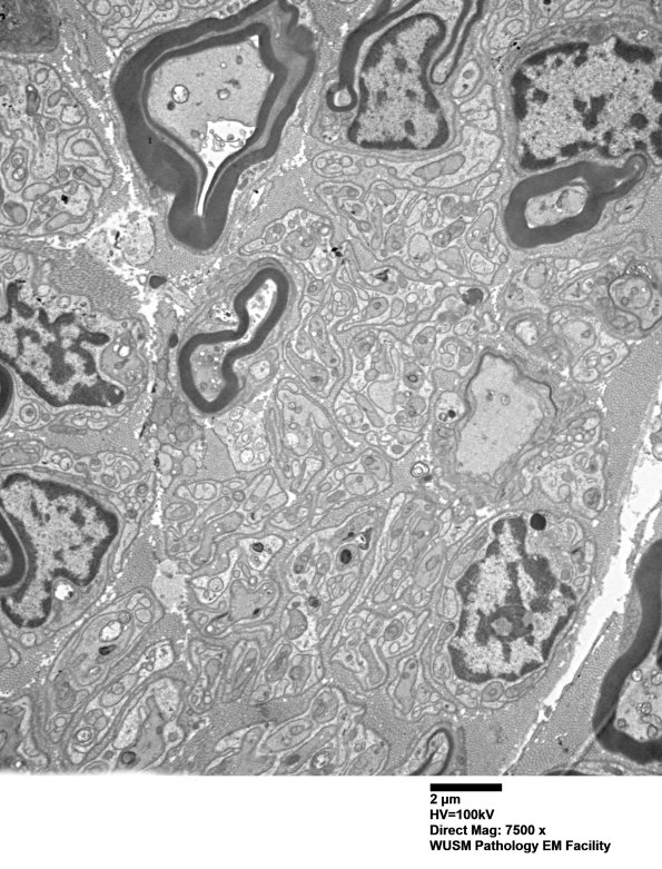 2B4 W20-132 A (Case 2) tibial_004 - Copy