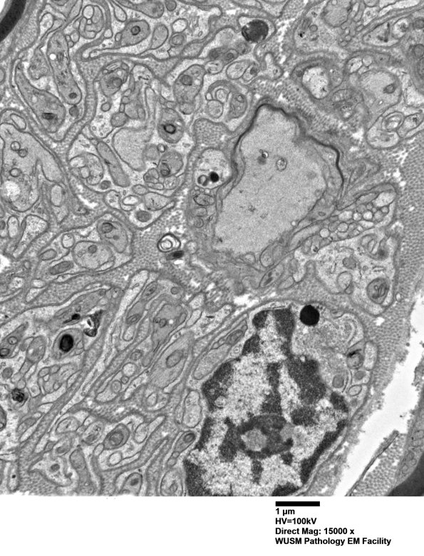 2B5 W20-132 A (Case 2) tibial_006 - Copy