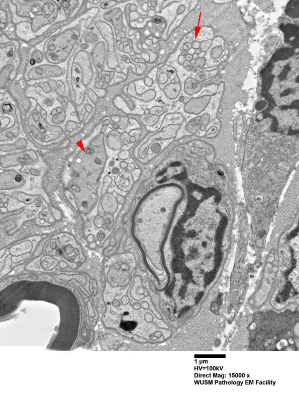 2B6 W20-132 A (Case 2) tibial_008 - Copy copy
