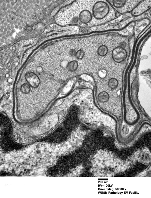 2B7 W20-132 A (Case 2) tibial_010 - Copy