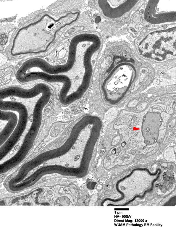 2B8 W20-132 A (Case 2) tibial_011 - Copy copy