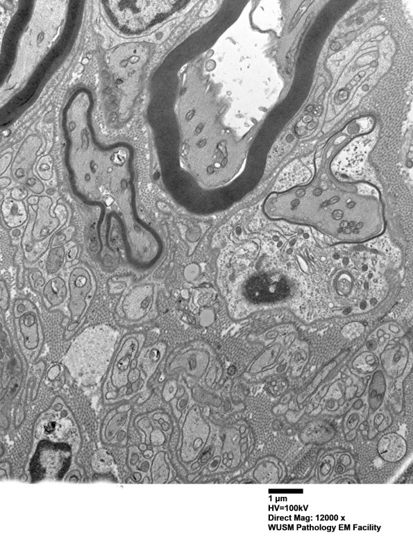 2B9 W20-132 A (Case 2) tibial_013 - Copy