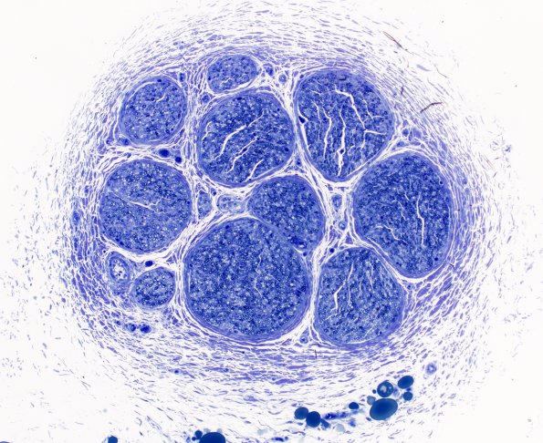 3A1 Nerve, sural, infant, 4 wk (Case 3) 4X
