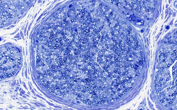 3A2 Nerve, sural, infant, 4 wk (Case 3) 40XA