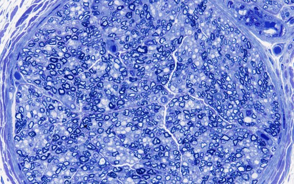 3A3 Nerve, sural, infant, 4 wk (Case 3) 60XA