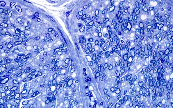 3A4 Infant, 4wk age (Case 3) Plastic 100X 1