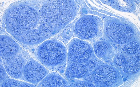 4A1 Infant, (Case 4) Plastic 20X 2