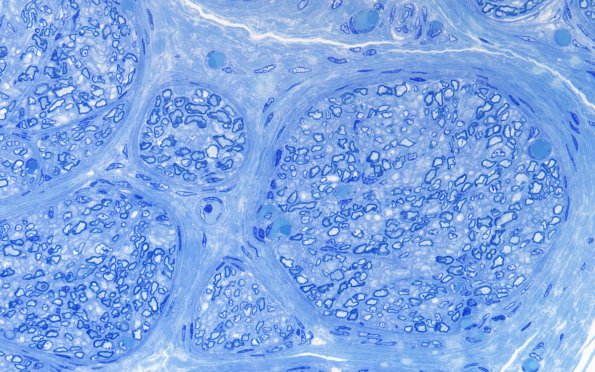 4A2 Infant, (Case 4) Plastic 60X 2