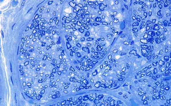 4A3 Infant, (Case 4) Plastic 100X 3