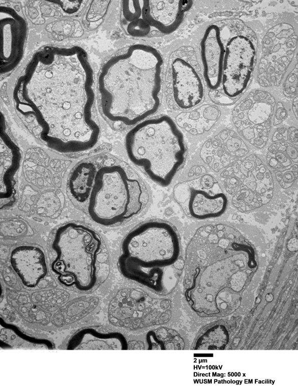 4B1 (Case 4) Sural_001 - Copy - Copy