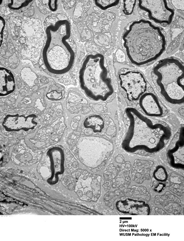4B2 (Case 4) Sural_002 - Copy - Copy